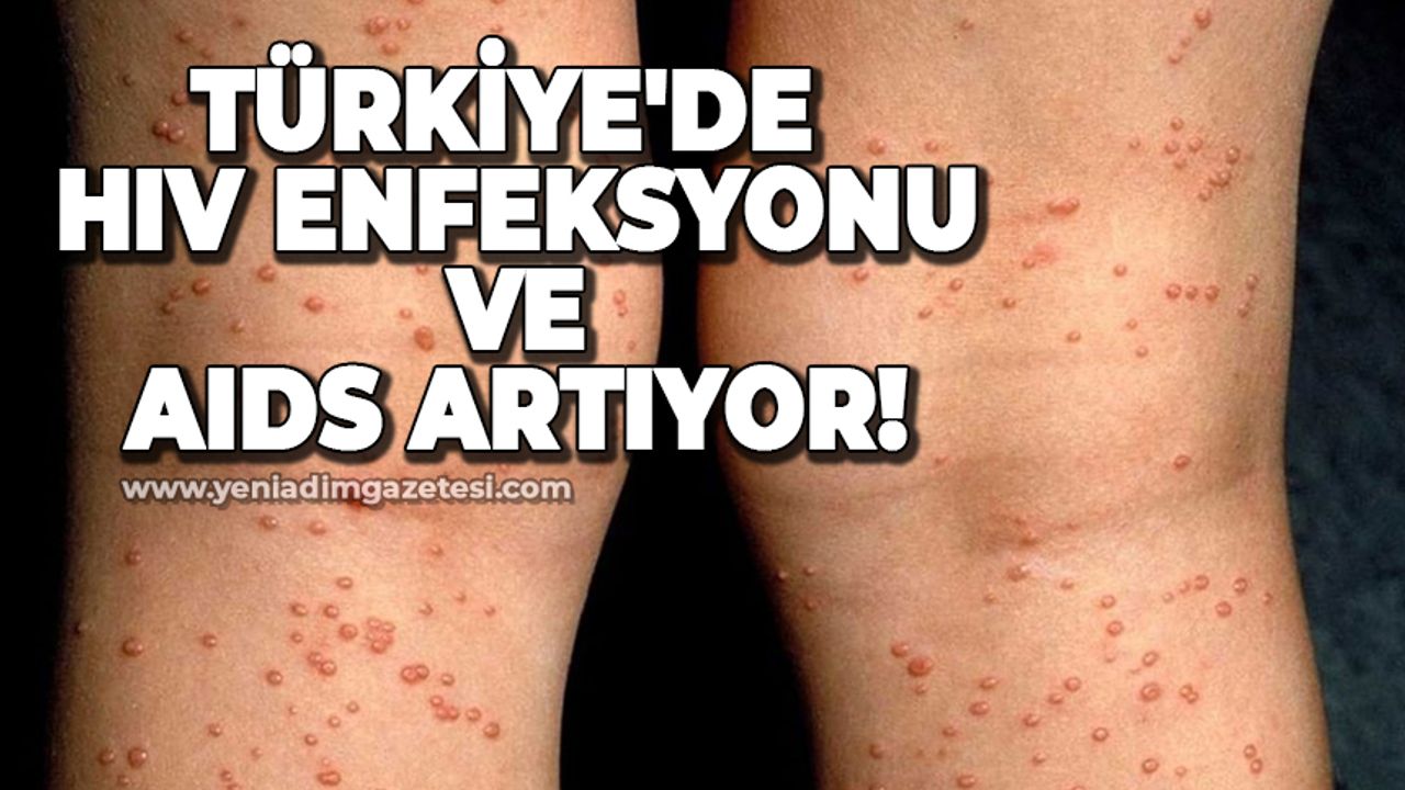 Türkiye'de HIV enfeksyonu ve AIDS artıyor!