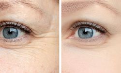 Göz çevresi yaşlanması nasıl önlenir?