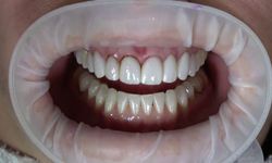 Emax diş tedavisi nedir?