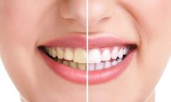 Dişler neden sararır? Tedavisi nedir?