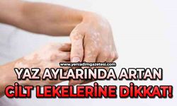 Yaz aylarında cilt lekelerine dikkat