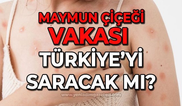 Maymun Çiçeği vakası Türkiye'yi saracak mı?