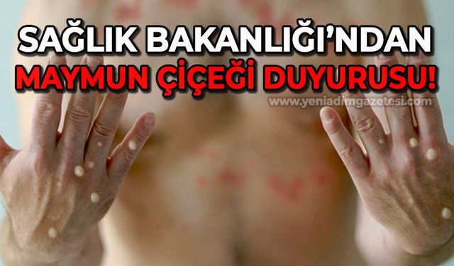 Sağlık Bakanlığı'ndan "Maymun Çiçeği" duyurusu!