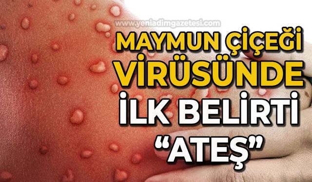 Maymun Çiçeği virüsünde ilk belirti ateş