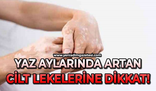 Yaz aylarında cilt lekelerine dikkat