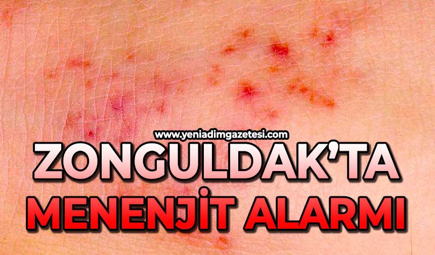 Zonguldak’ta menenjit alarmı